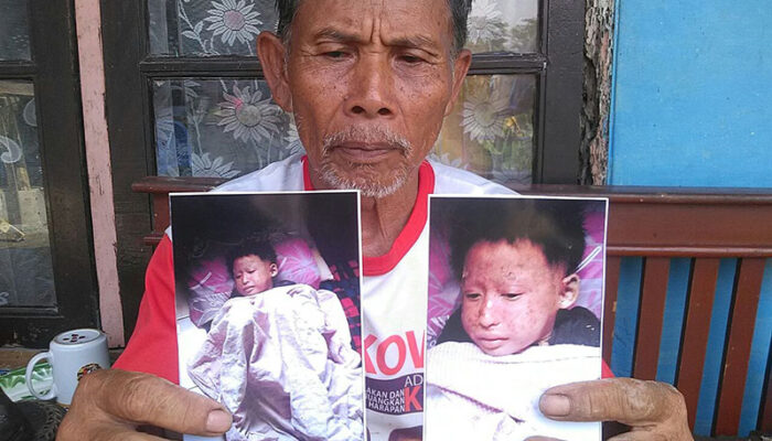 Bocah Bersisik Diisolasi di RSHS