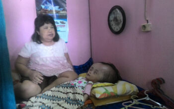 Sudah 6 Tahun Ririn Menderita Hydrocephalus