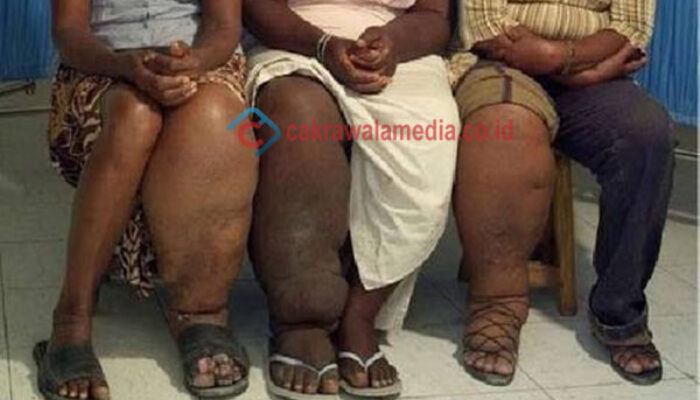 Kota Cimahi Aman Filariasis!