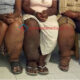 Kota Cimahi Aman Filariasis!