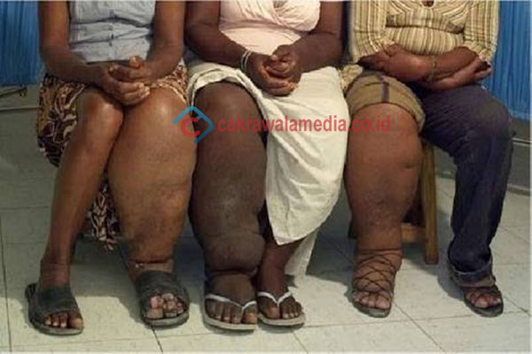 Kota Cimahi Aman Filariasis!