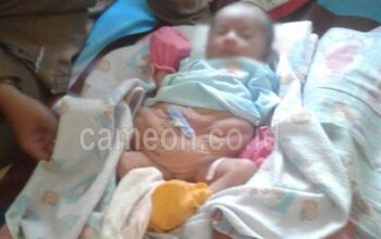Di Pangandaran Seorang Bayi Lahir Tanpa Otot Perut Butuh Uluran Tangan Dermawan