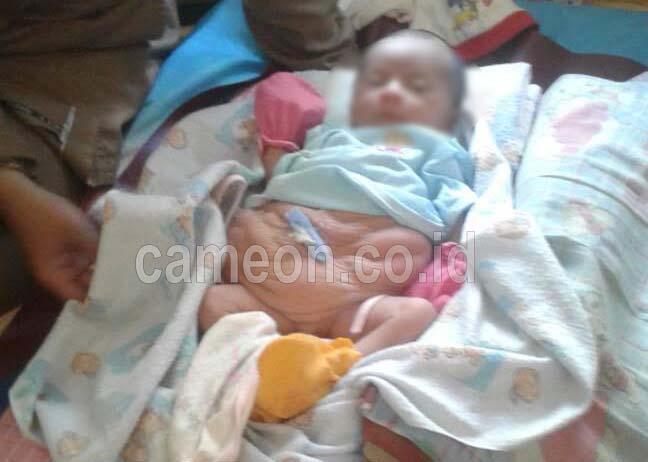 Di Pangandaran Seorang Bayi Lahir Tanpa Otot Perut Butuh Uluran Tangan Dermawan