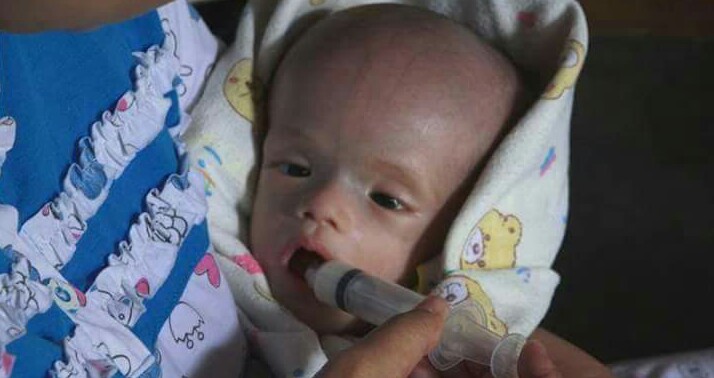 Alfarizky Bayi 50 Hari Penderita Spina Bipida, Tak Mampu Berobat