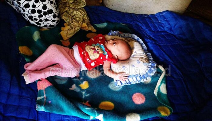 Penderita Gizi Buruk di Cisayong, Perlu Perhatian Pemerintah