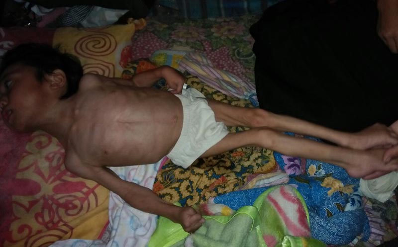 Silvia Putri, Bocah Penderita Gizi Buruk di Garut Perlu Perhatian Pemerintah
