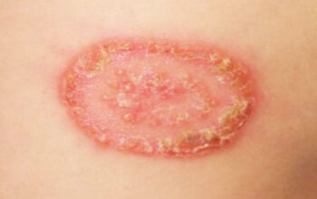 Mengobati Kurap Secara Alami