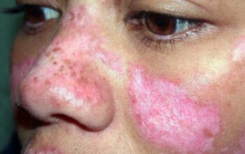 Mencegah Penyakit Lupus