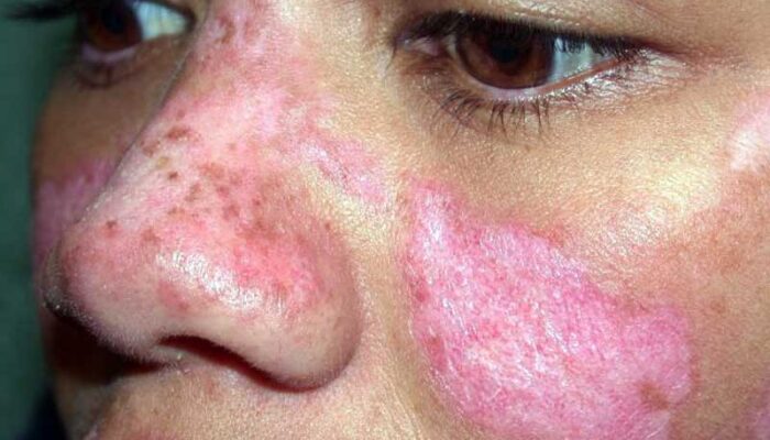 Mencegah Penyakit Lupus