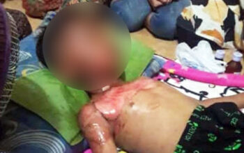 Aduh, Afi Kecil Tersiram Spirtus dan Terbakar