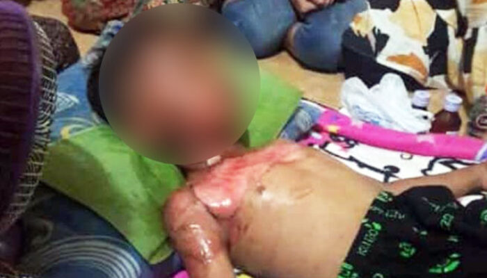 Aduh, Afi Kecil Tersiram Spirtus dan Terbakar