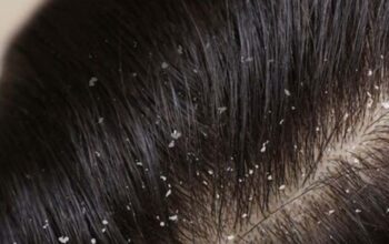 Mengatasi Rambut Berketombe; Tips dan Trik untuk Kesehatan Kulit Kepala yang Optimal