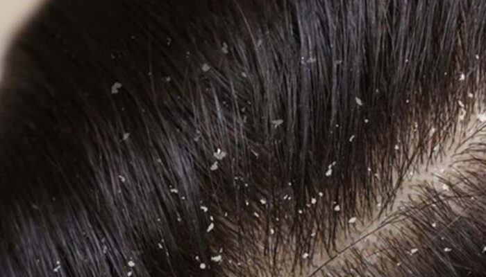 Mengatasi Rambut Berketombe; Tips dan Trik untuk Kesehatan Kulit Kepala yang Optimal