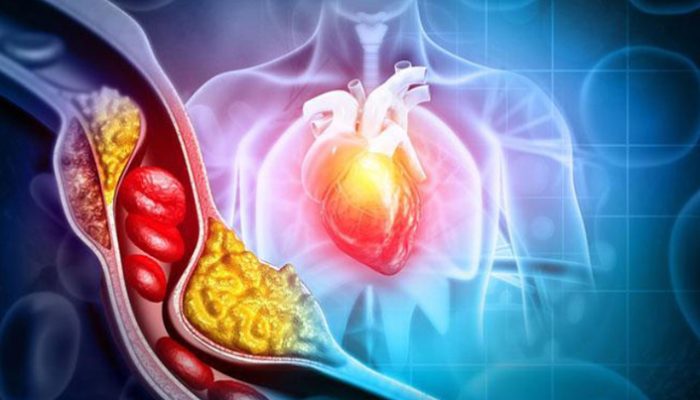 Kolesterol Tinggi? Inilah 7 Langkah Alami untuk Mengatasinya